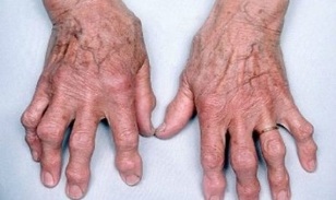 nola bereiztu behatzen artritisa artrosisetik