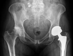 hip artikulazioko artrosiaren diagnostikoa